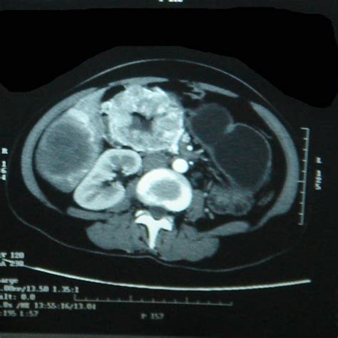 Partial response of duodenal tumor. | Download Scientific Diagram