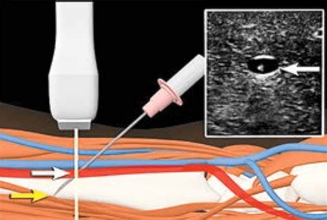 Ultrasound Guided Insertion Of A Radial Arterial Catheter Pocus Academy