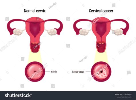 Dysplasia Stages Over 20 Royalty Free Licensable Stock Vectors