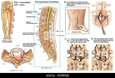 L2 3 Disc Herniation With Laminectomy And Discectomy Stock Photo