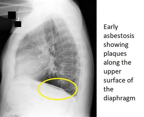 Occupational lung disease x ray - wikidoc