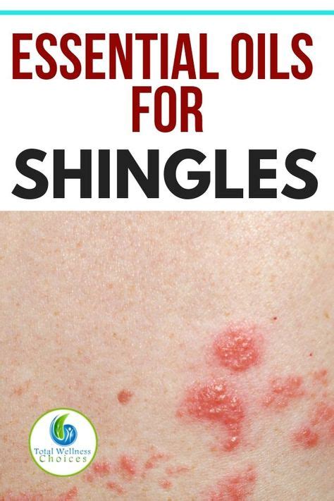 9 Best Essential oils for shingles ideas | essential oils for shingles ...