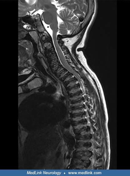 Mpolac Medlink Neurology