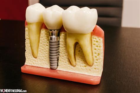 Are Dental Implants Safe Learn The Advantages And Risks