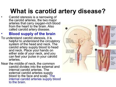 Carotid artery disease