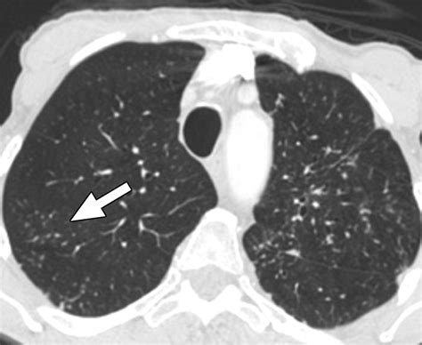 Arthritis Nodules On Lungs