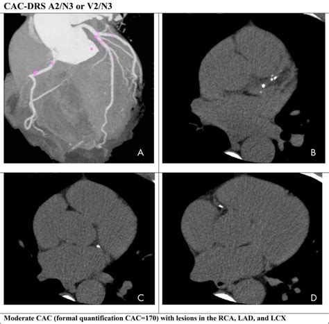 An Update On Coronary Artery Calcium Interpretation At Chest And