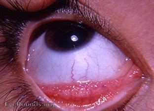 allergic conjunctivitis. EyeRounds.org: Online Ophthalmic Atlas