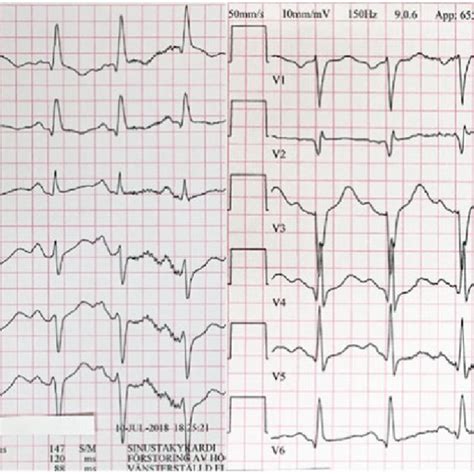 The Initial Electrocardiogram Showed Sinus Tachycardia Without Apparent