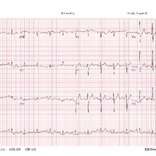 An Electrocardiogram On The Day Of Admission Shows Normal Sinus Rhythm