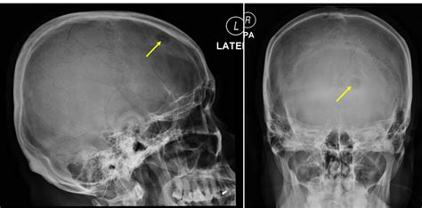 Lytic Skull Metastasis Radiology Cases