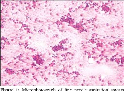 Figure From Gastric Adenocarcinoma Deposits Presenting As Multiple