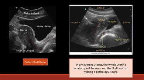 Ultrasound Female Pelvis Collection Of Ultrasound Images Ultrasound