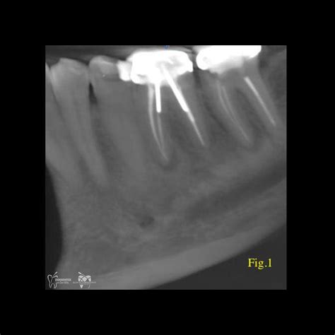 Does dental CT scan help with the diagnosis of a vertical root fracture ...