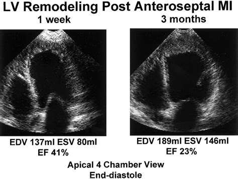 Left Ventricular Remodeling After Myocardial Infarction Circulation