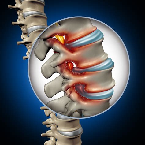 Spinal Stenosis Treatment | Minimally Invasive Spine Surgery