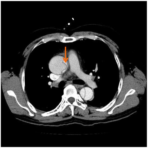 Typical Preoperative Computed Tomography The Arrow Indicates The