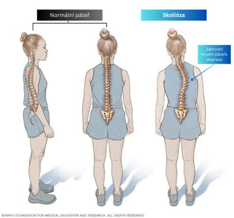 Skolióza Od projevů diagnostiky až po léčbu zakřivení páteře