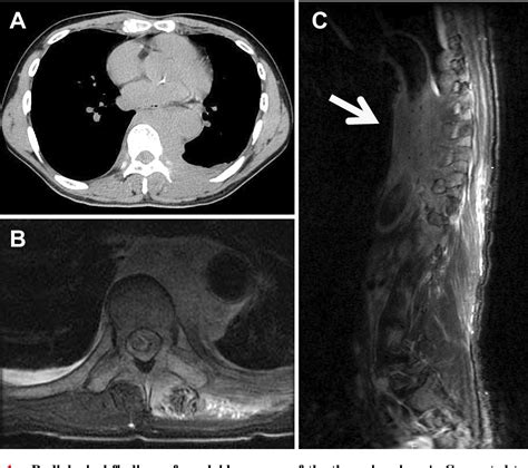 Figure 1 from Acute myeloid leukemia concurrent with spinal epidural extramedullary myeloid ...