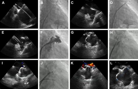 Intracardiac Echocardiography To Guide Watchman Flx Implantation The