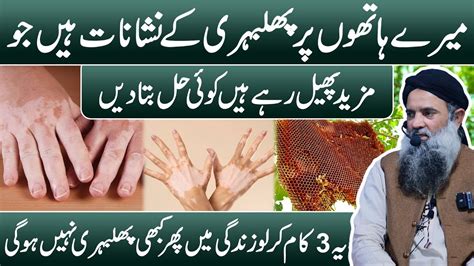 Phulbari Ka Ilaj Bars Ki Bimari Ka Ilaj Vitiligo Treatment Safed