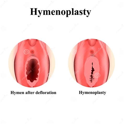 structure   vulva hymen hymenoplasty hymen  defloration