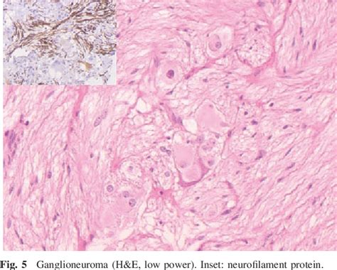 Primary Giant Cell Rich Osteosarcoma Of The Urinary Bladder Usefulness