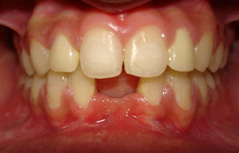 Management Of Peg Shaped Lateral Incisors And Missing Mandibular