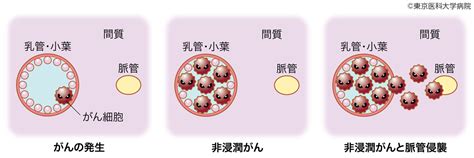 乳がんの基礎知識｜乳がん 西新宿の地で がんに挑む 東京医科大学病院