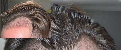 How Long Does a Hair Transplant Last?