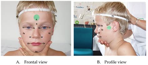 Jcm Free Full Text Cranio Facial Characteristics In Children With