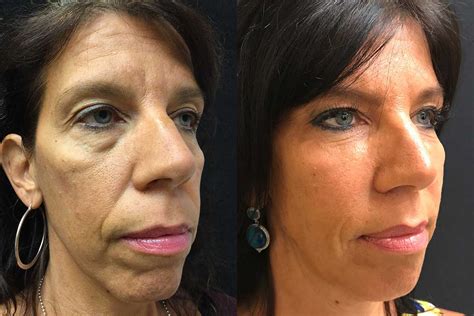 Radiesse Before And After Smile Lines