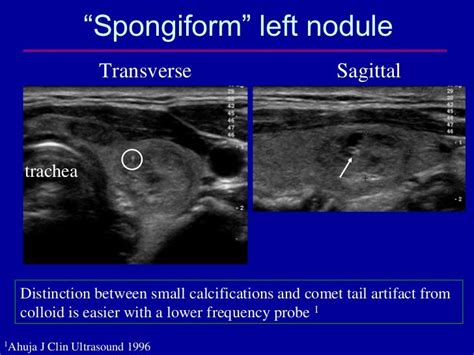 “Spongiform” left nodule Transverse Sagittal trachea Distinction betw...