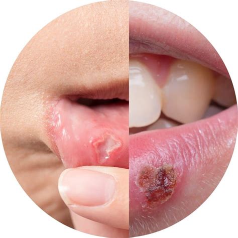 Cold Sores Symptoms Causes Treatment And More Off