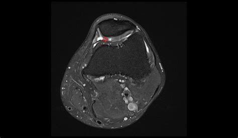 Chondromalacia MRI | Radiology Article on chondromalacia patellae