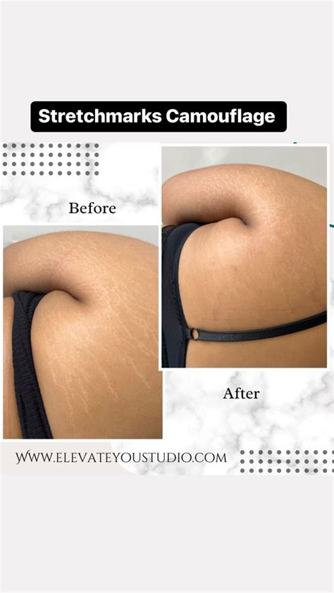 Mommy Makeover Permanent Makeup Stretch Marks Beauty Full Girl Home