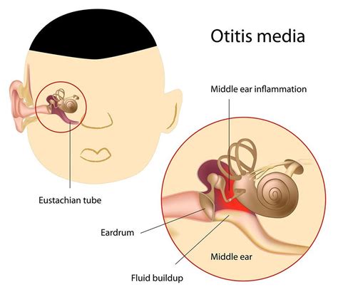 Otitis Media Penyebab Gejala Jenis Dan Pengobatan