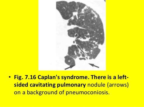 7 Diffuse Lung Disease