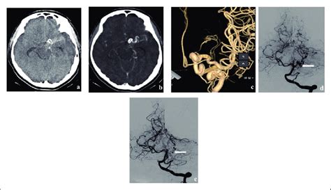 A Case Of Dolichoectasia At The Left Ica And P Segment Of The Left Pca