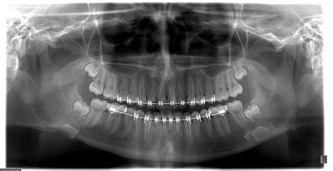 Radiografia Panor Mica Ortopantomografia Pantomografia