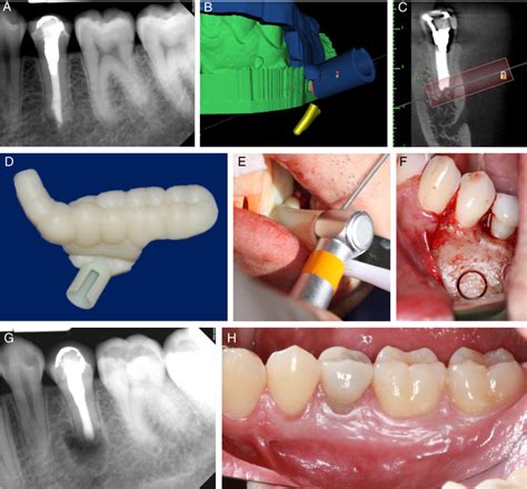 Targeted Endodontic Microsurgery A Novel Approach To Anatomically Challenging Scenarios Using 3