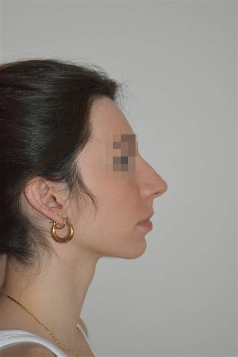 Rhinoplastie Conservatrice ultrasonique avant après