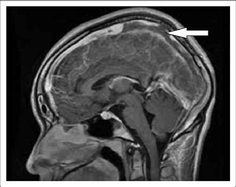 Inferior Sagittal Sinus Mri