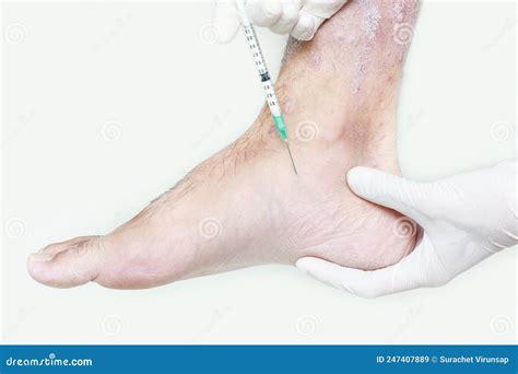 Treatment of psoriasis stock image. Image of psoriasis - 247407889