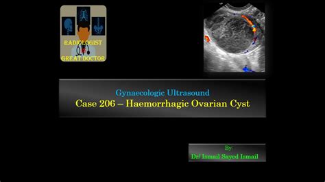 Ultrasound Case 206 Haemorrhagic Ovarian Cyst Youtube