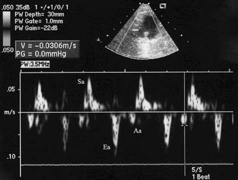 magem ecocardiográfica bidimensional e em Doppler tecidual pulsado da