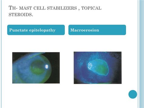 Ppt Disorders Of The Eyelids Powerpoint Presentation Free Download Id2161308