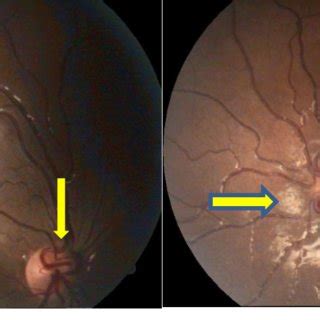 A: Clinical photo right eye: arteriovenous anastomosis (vertical yellow ...