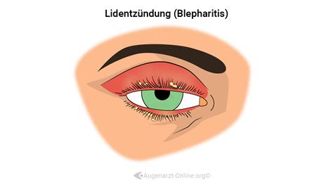 Blepharitis Lexikon Der Augenheilkunde