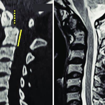 Spinal Cervical Lateral Plain Radiography A Sagittal Computed